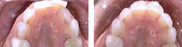 Tooth Straightening Henderson