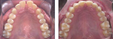 Tooth Straightening Henderson