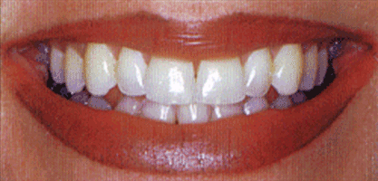 Teeth Whitening Las Vegas