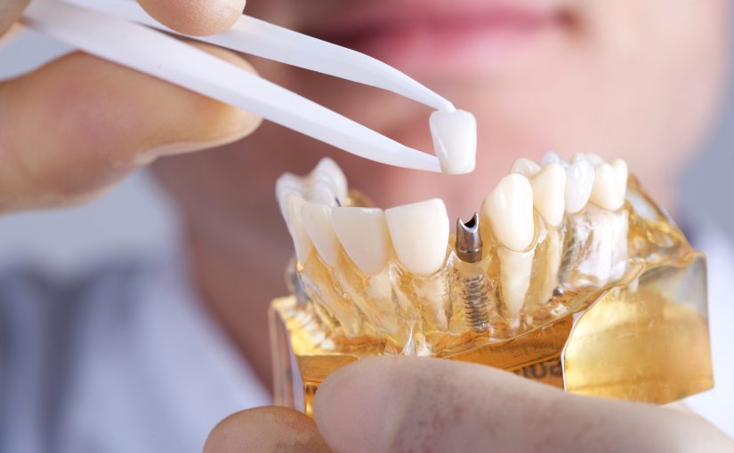 Replace Your Missing Teeth With Dental Implants