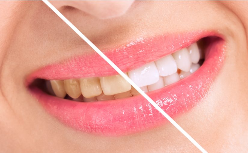 Teeth Whitening Methods To Enhance Your Smile - Foutz ...