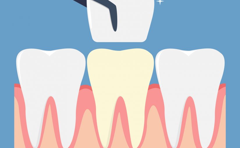 “No-Prep” Veneers Could Eliminate The Need To Remove Tooth Enamel