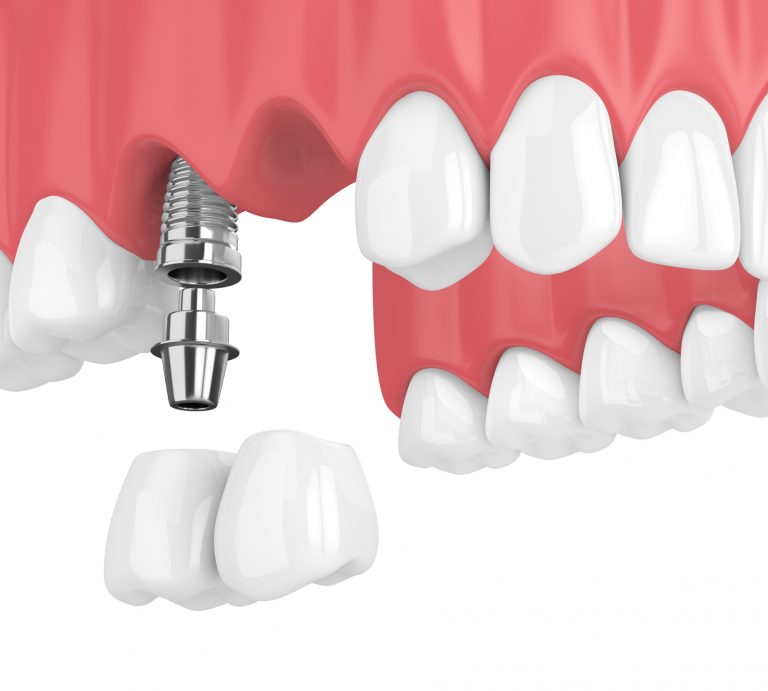 3d render of implants with dental cantilever bridge - Foutz Family ...