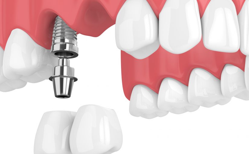 Considering Bridgework Over Dental Implants