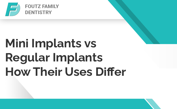 Mini Implants vs. Regular Implants: How their Uses Differ